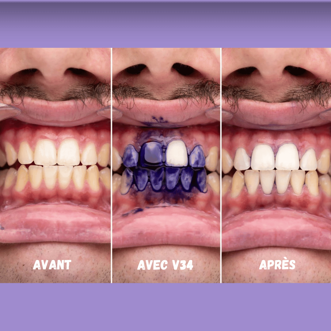 V34 Sérum Blanchissant Violet – Correcteur Instantané pour un Sourire Éclatant (30ml) - Polynesia Market